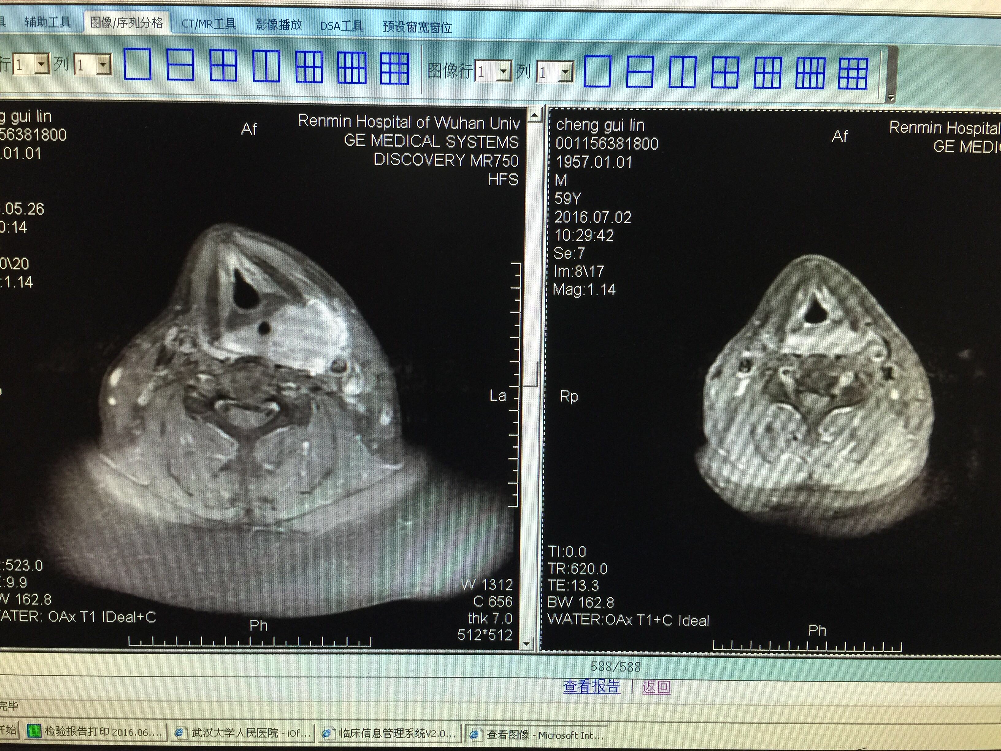 下咽癌手术后图片图片