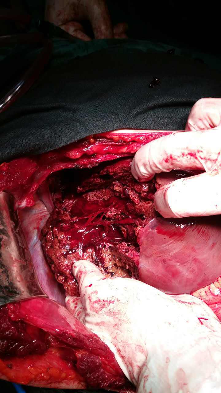 输血1万多毫升的肝静脉撕裂性肝破裂 - 好大夫在线