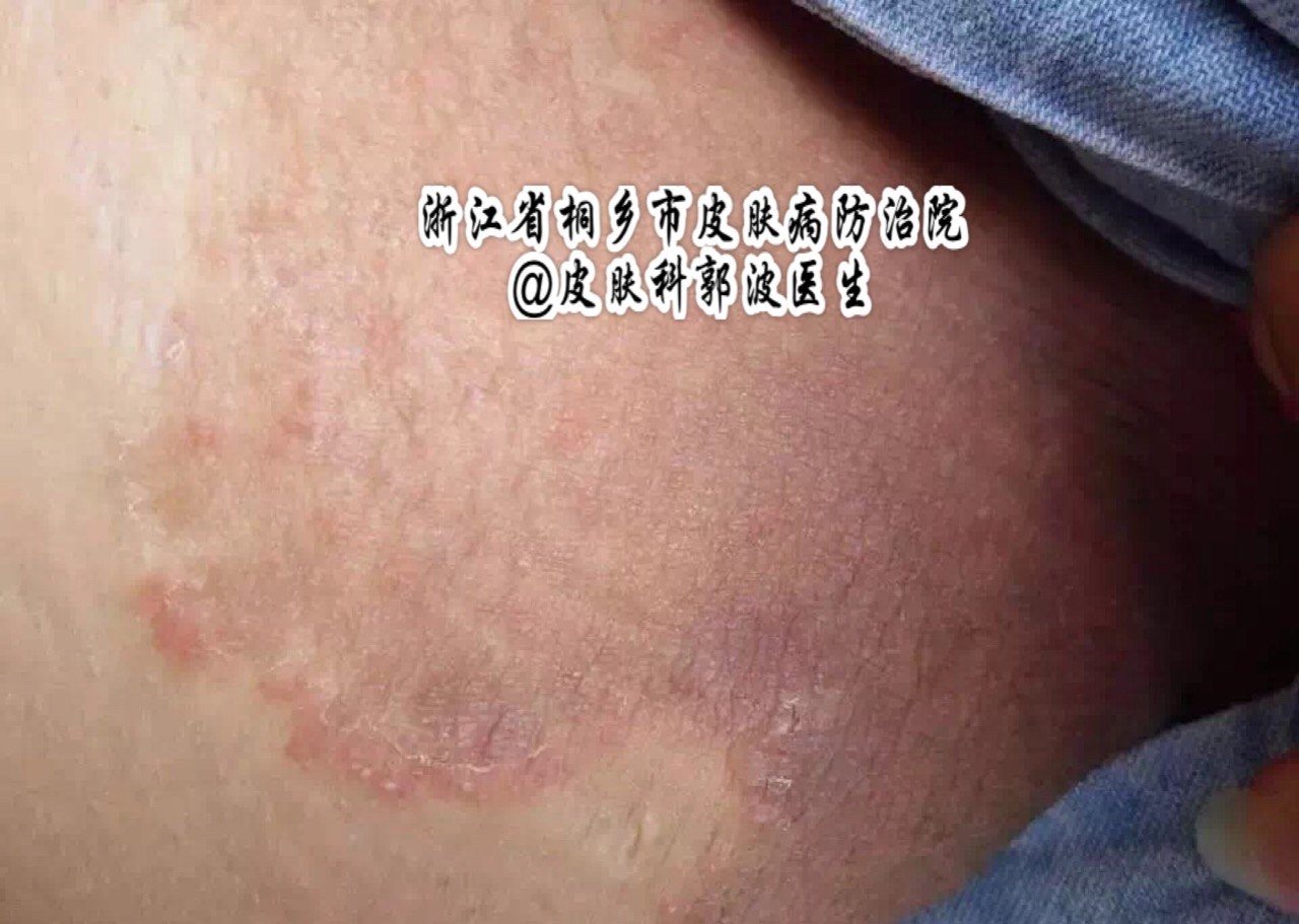 大腿根得了股癣 到底该怎么办呢 大腿根得了股癣 到底该怎么办呢