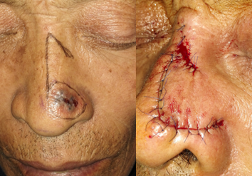 基底细胞癌的手术治疗 - 好大夫在线