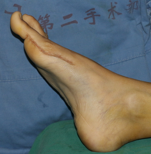 拇外翻术前术后对比 - 好大夫在线