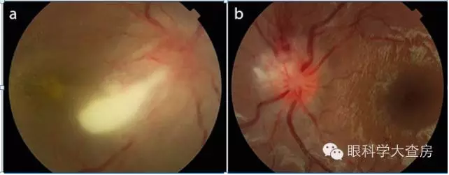 眼底鏡檢查發現:右眼視神經乳頭水腫( )伴出血,大量滲出物沿著顳下