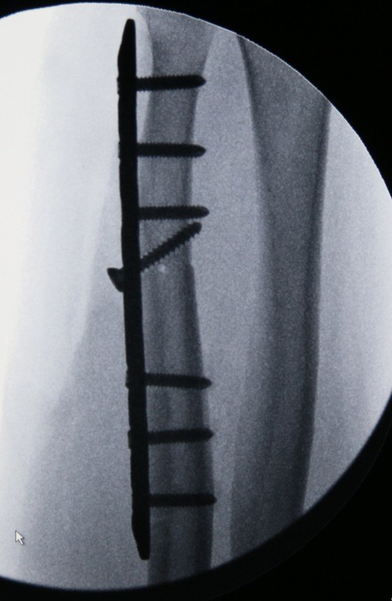 尺骨骨折手术钢板图片图片