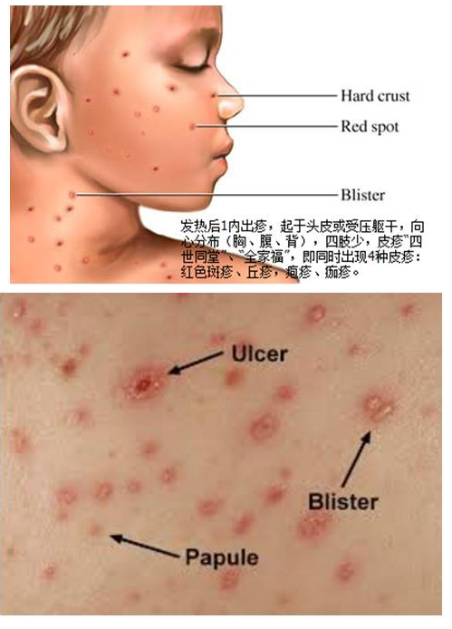 我看过最好的小儿感染性出疹性疾病皮疹图库