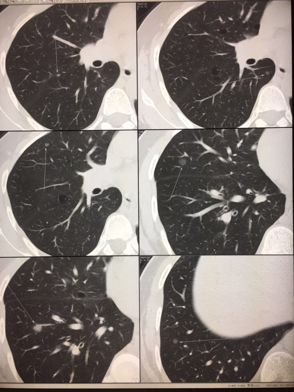 肺段切除在多发性肺结节,毛玻璃影中的应用