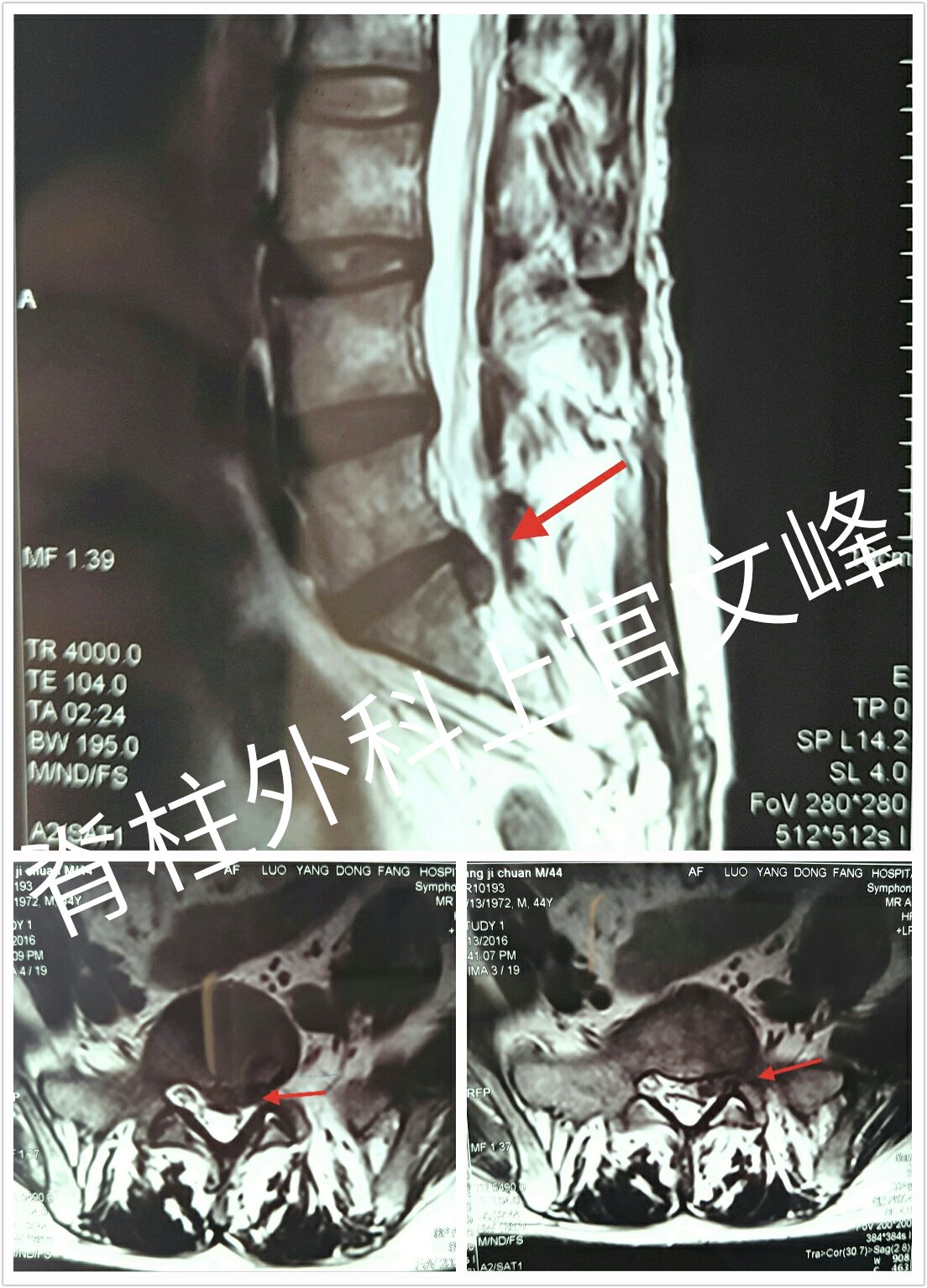 脊柱內鏡椎板間入路治癒l5s1椎間盤突出症