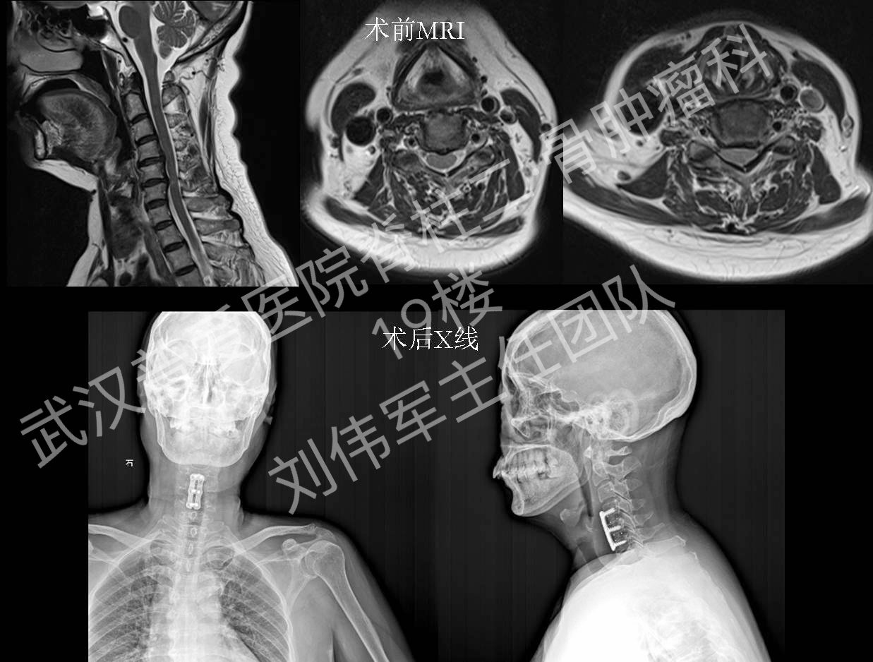 2016年刘主任团队典型病例:脊髓型颈椎病-前路