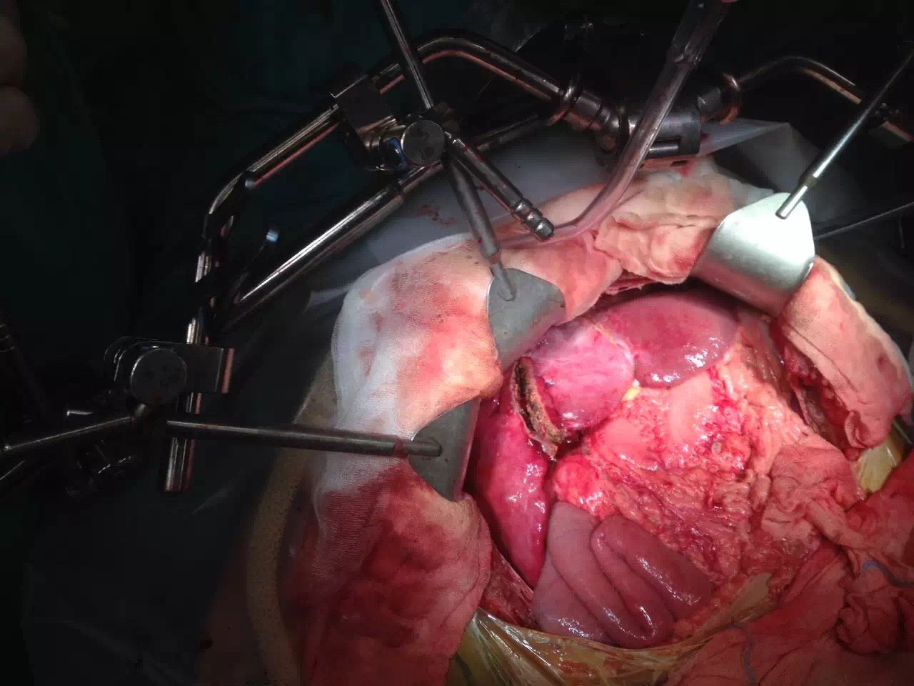 活体肝移植:供肝不足,母子拼肝术 - 好大夫在线