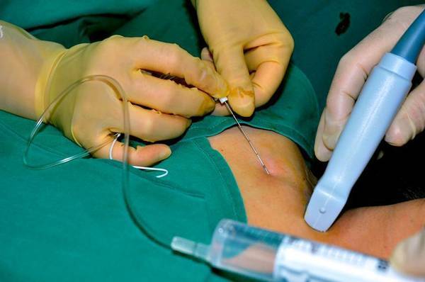 目的:本研究的目的是探讨右美托咪啶和酮咯酸作为局部麻醉辅助剂对