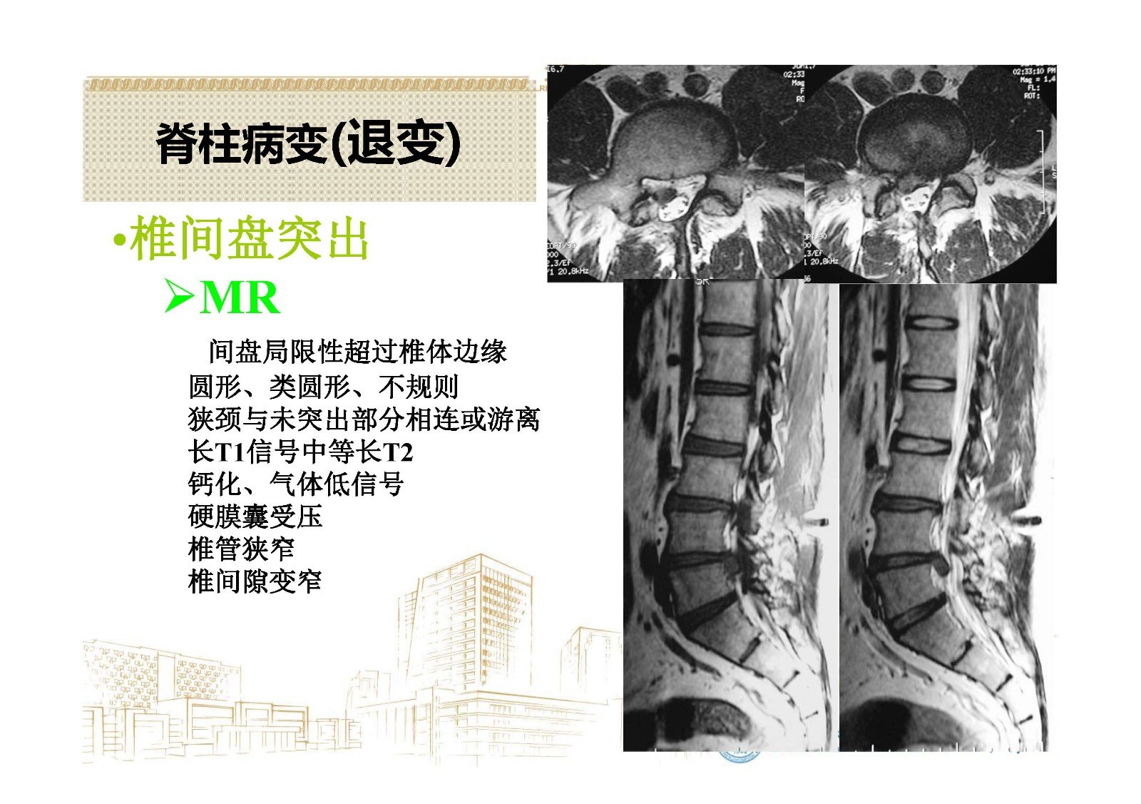 脊柱退行性病变的影像诊断