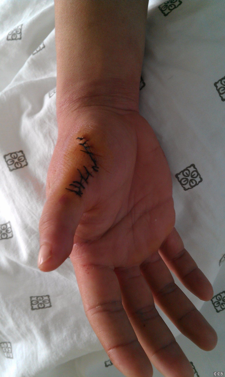六指手术后10天图片图片