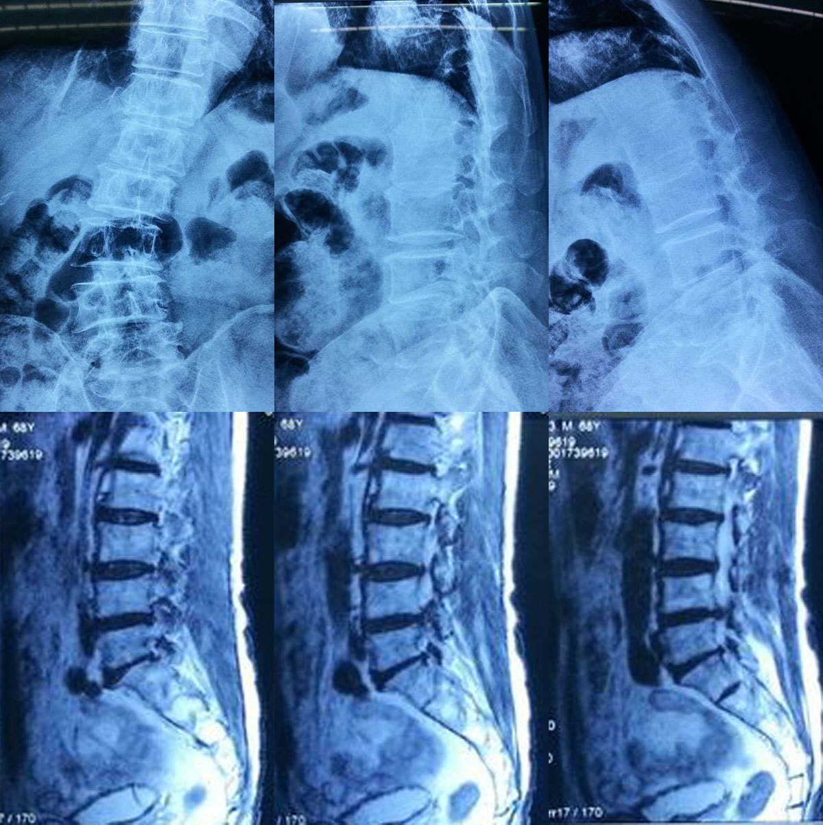 脊柱畸形矫正术(青少年脊柱侧弯,半椎体,后突驼背等) - 好大夫在线