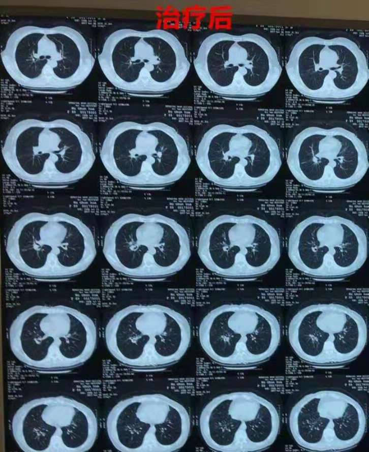 他们的肺部结节竟然都消失了 - 好大夫在线