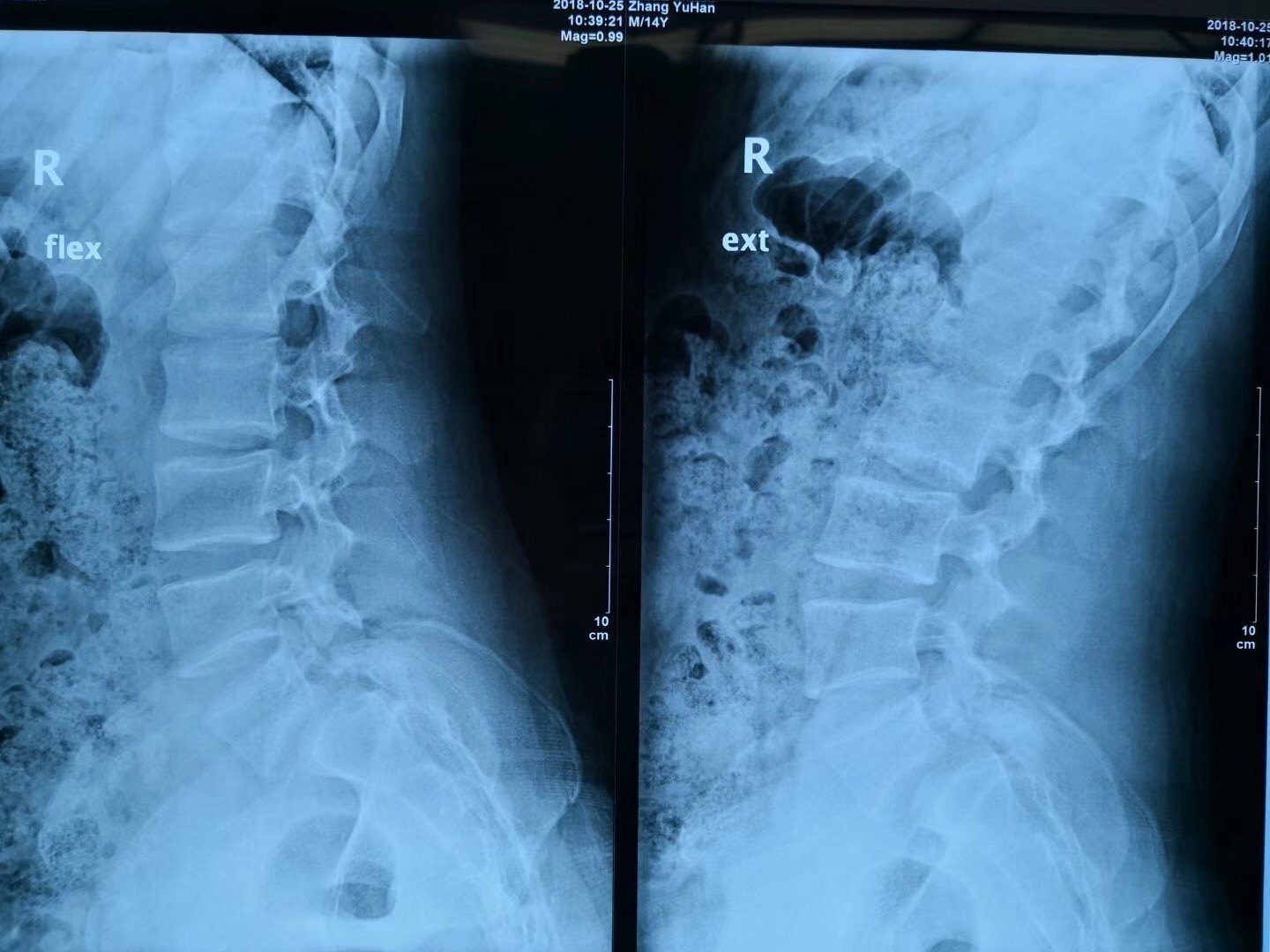 腰椎滑脱2度-内固定植骨融合术记录 - 知乎