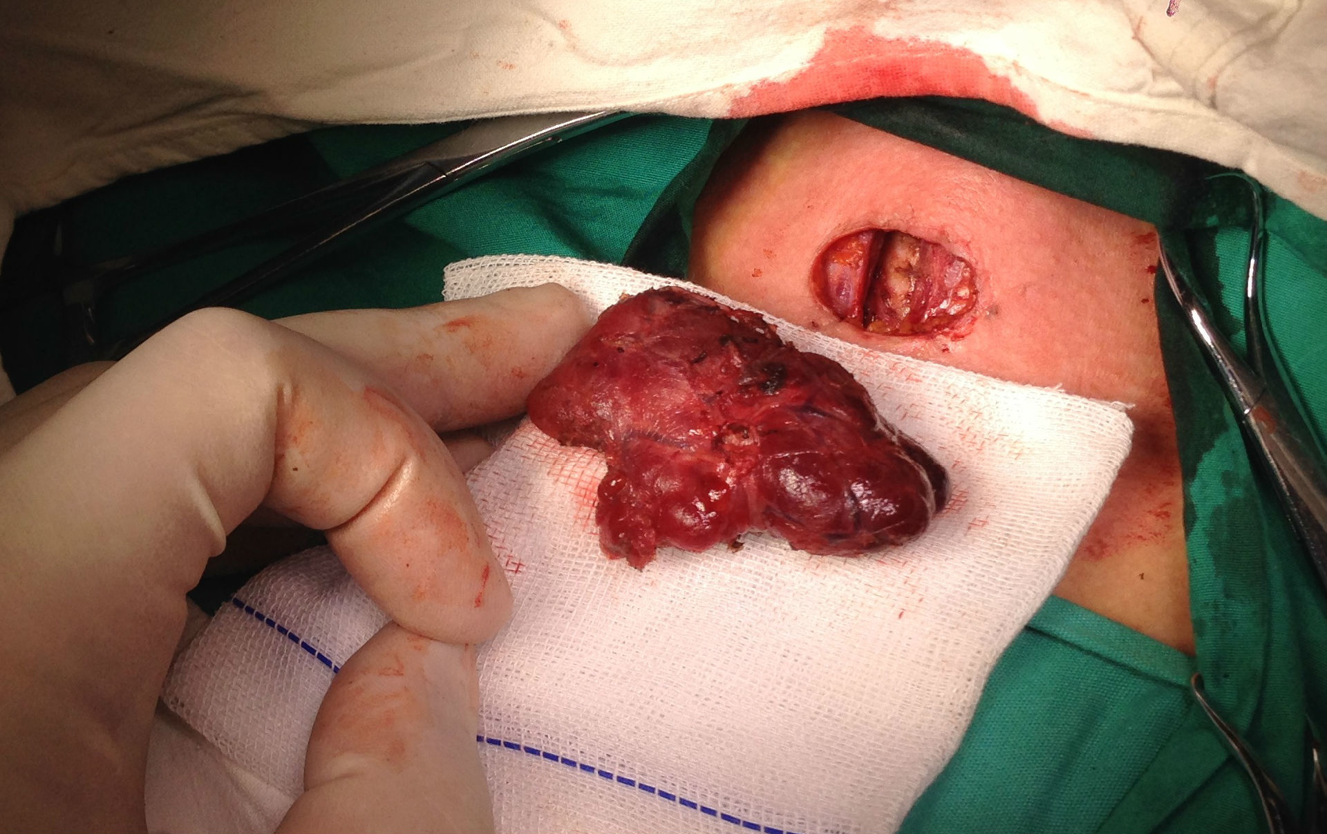 术后病理报告:左侧甲状腺乳头状微小癌,左侧6区淋巴结无转移(0/4).