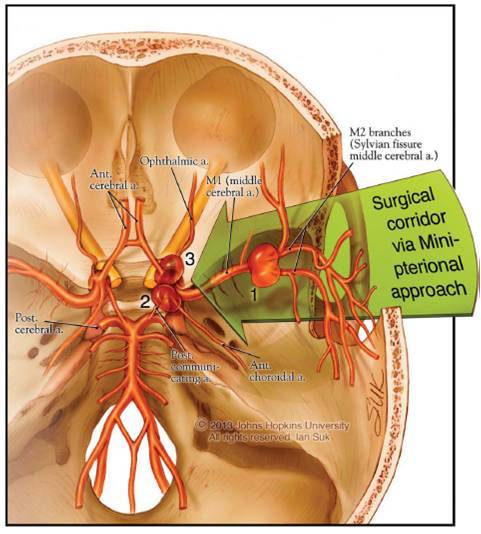 脉络膜裂解剖图片