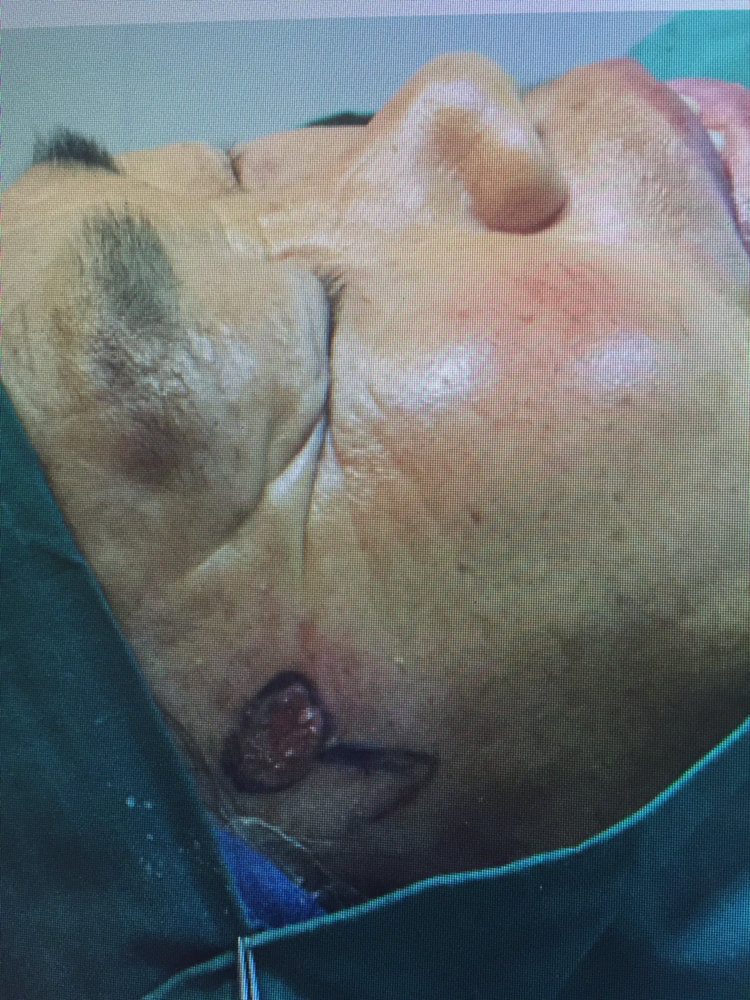 面部皮肤肿瘤的处理