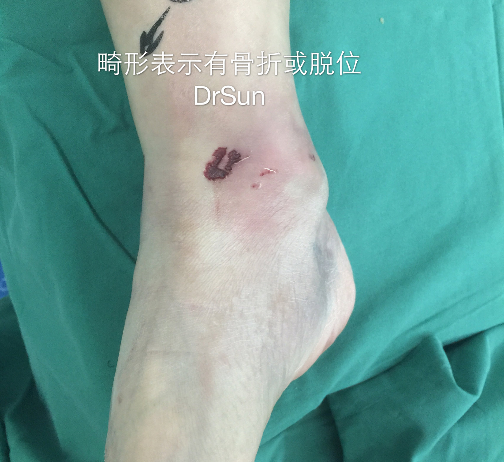 外踝撕脱造成骨片卡于关节间隙持续疼痛内侧三角韧带撕裂需要韧带止点