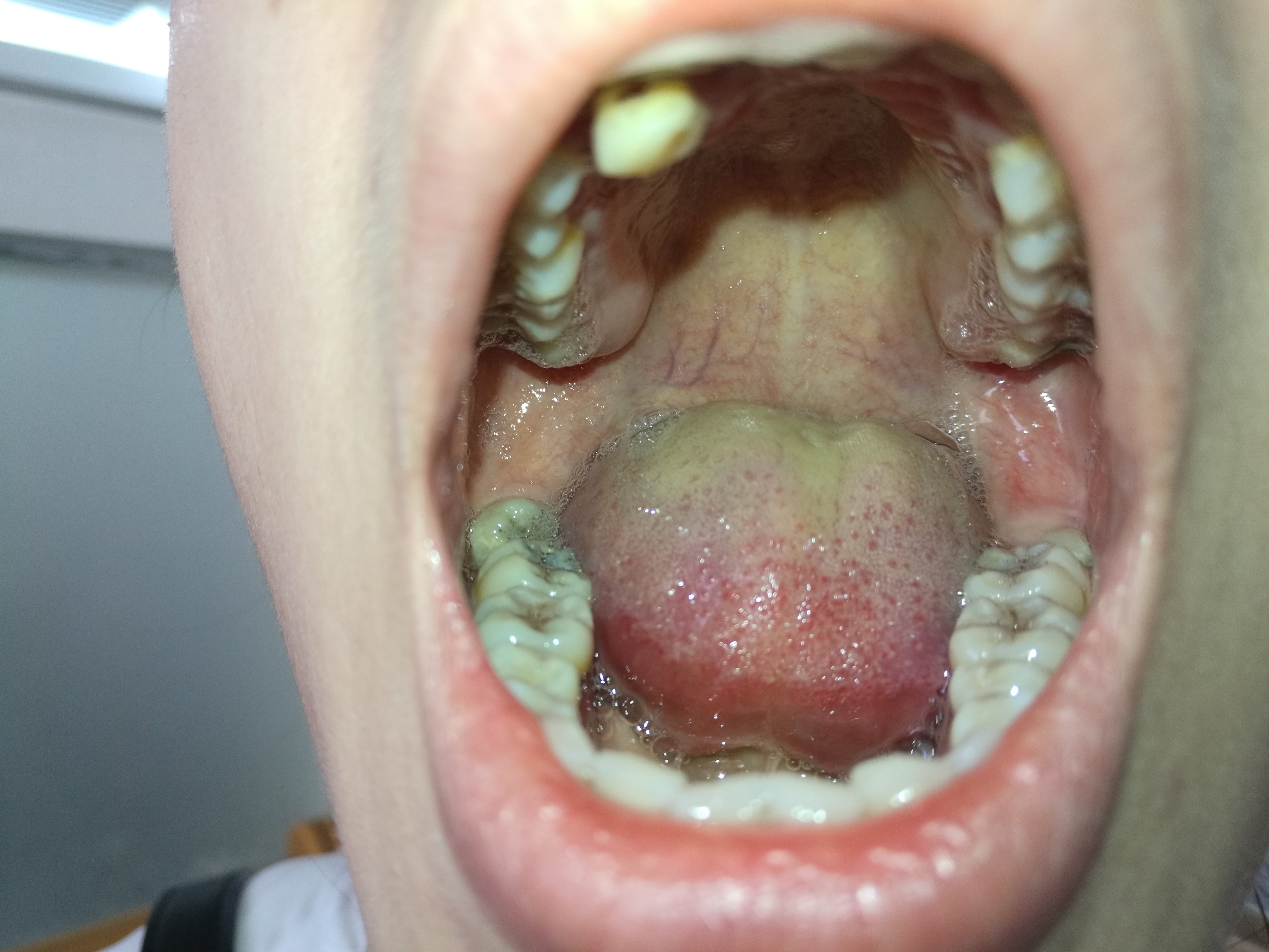 干燥综合症牙齿图片