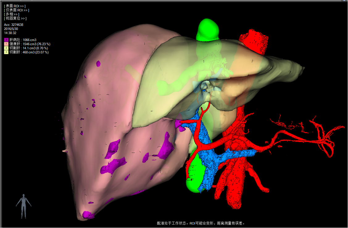 肝切除術(associating liver partition and portal vein ligation