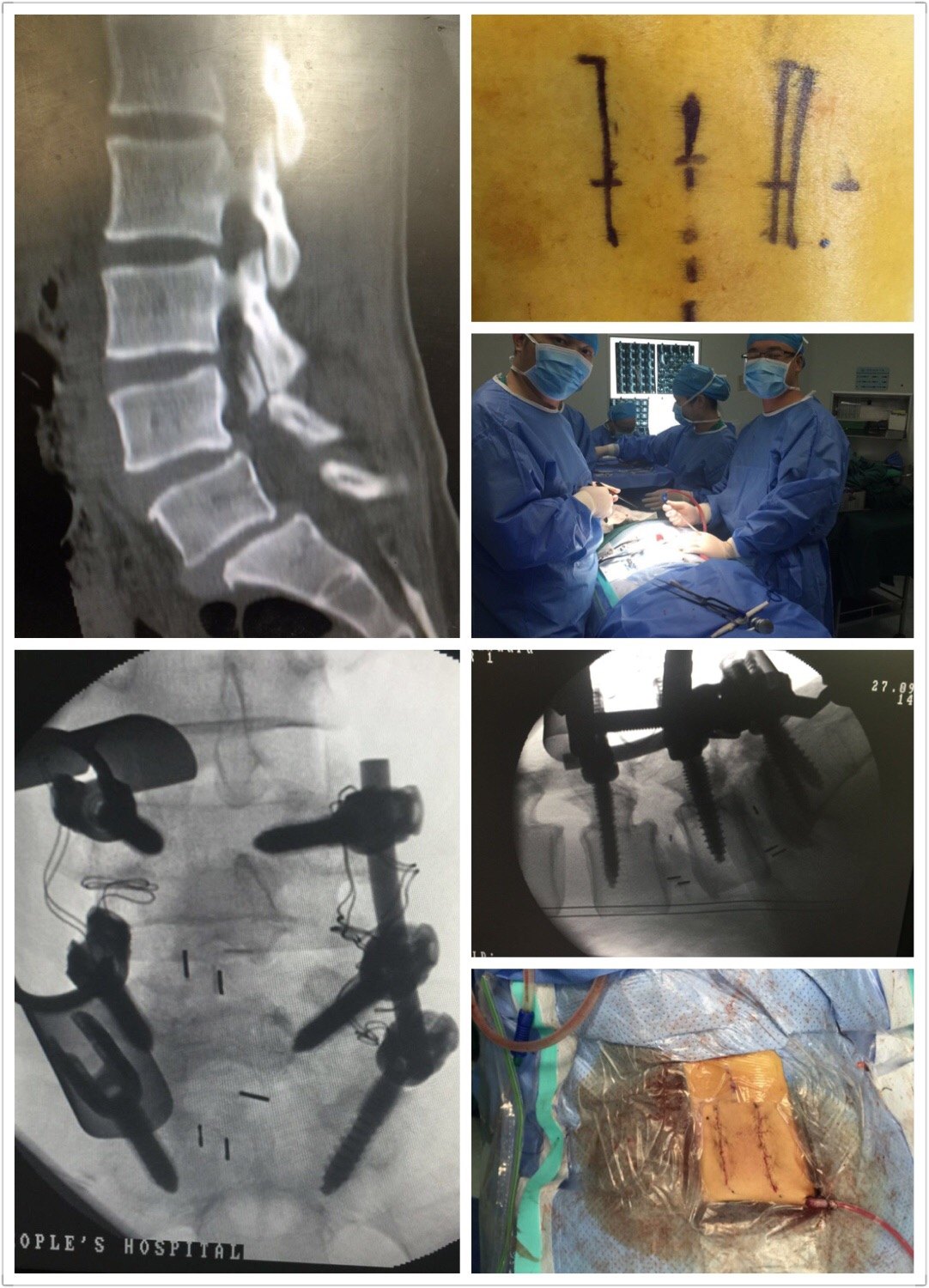 微创手术治疗腰椎滑脱症的优势 - 好大夫在线