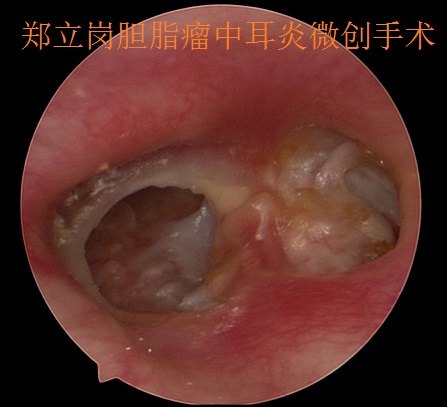 膽脂瘤中耳炎小切口微創手術第340廣東佛山三水