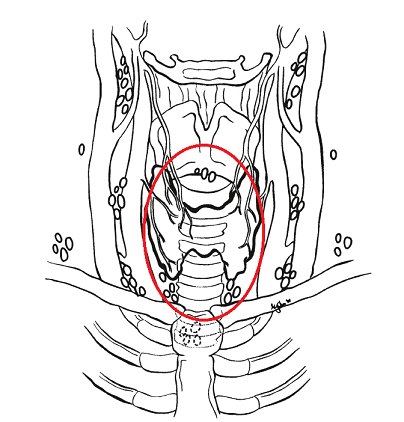 甲状腺结节消融:乳头状癌中央区淋巴结不消融