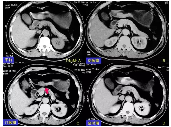 胃癌增强CT图像图片