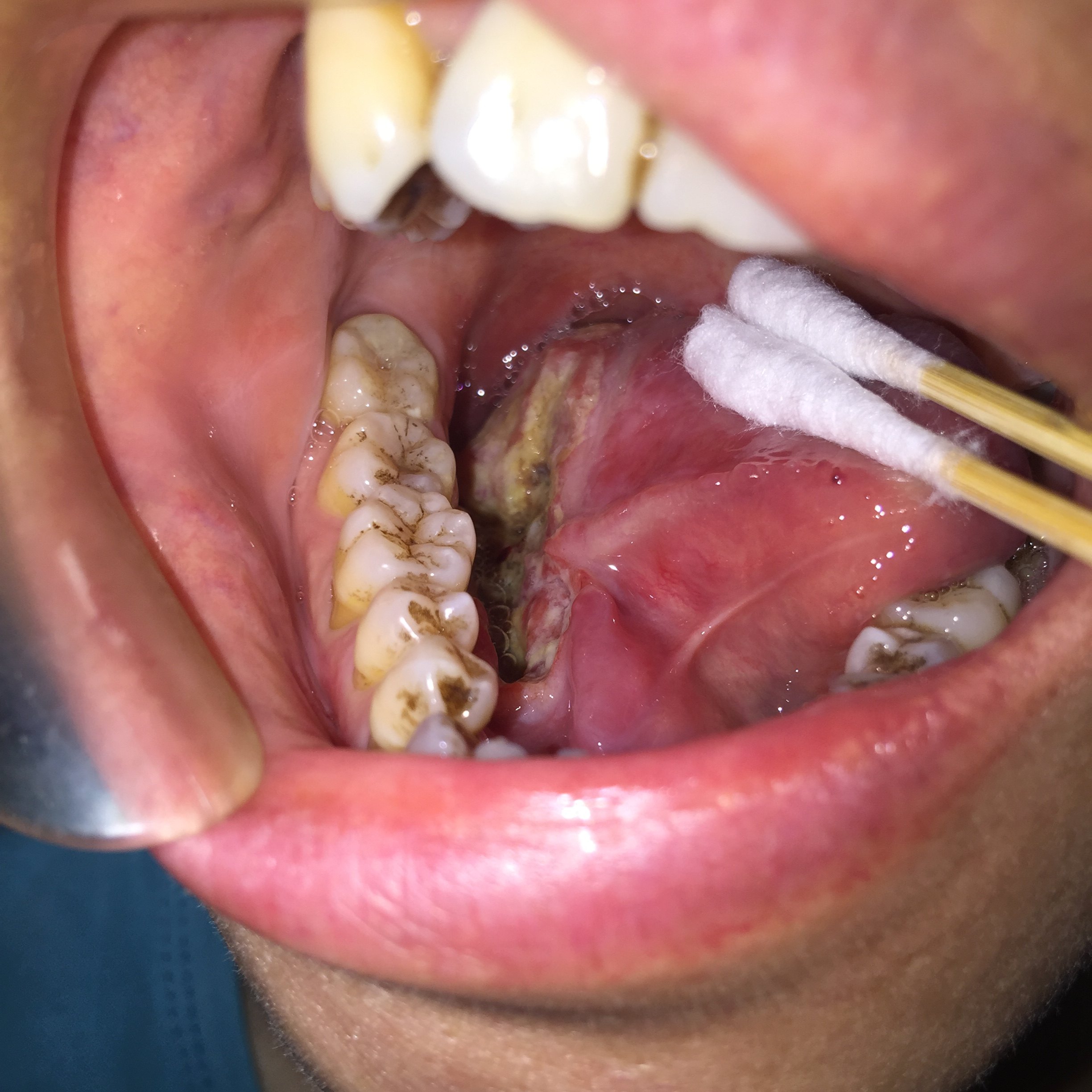 舌癌与非舌癌的图片比较 