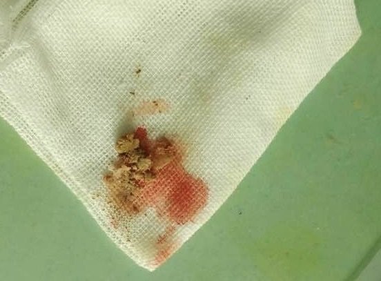 东西是我和李医生2天前给一位"肛周脓肿"病人切开时从"脓"腔里出来的