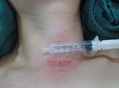 甲状腺手术颈部切口及疤痕 (图) 颈部无疤痕的腔镜手术 - 好大夫在线