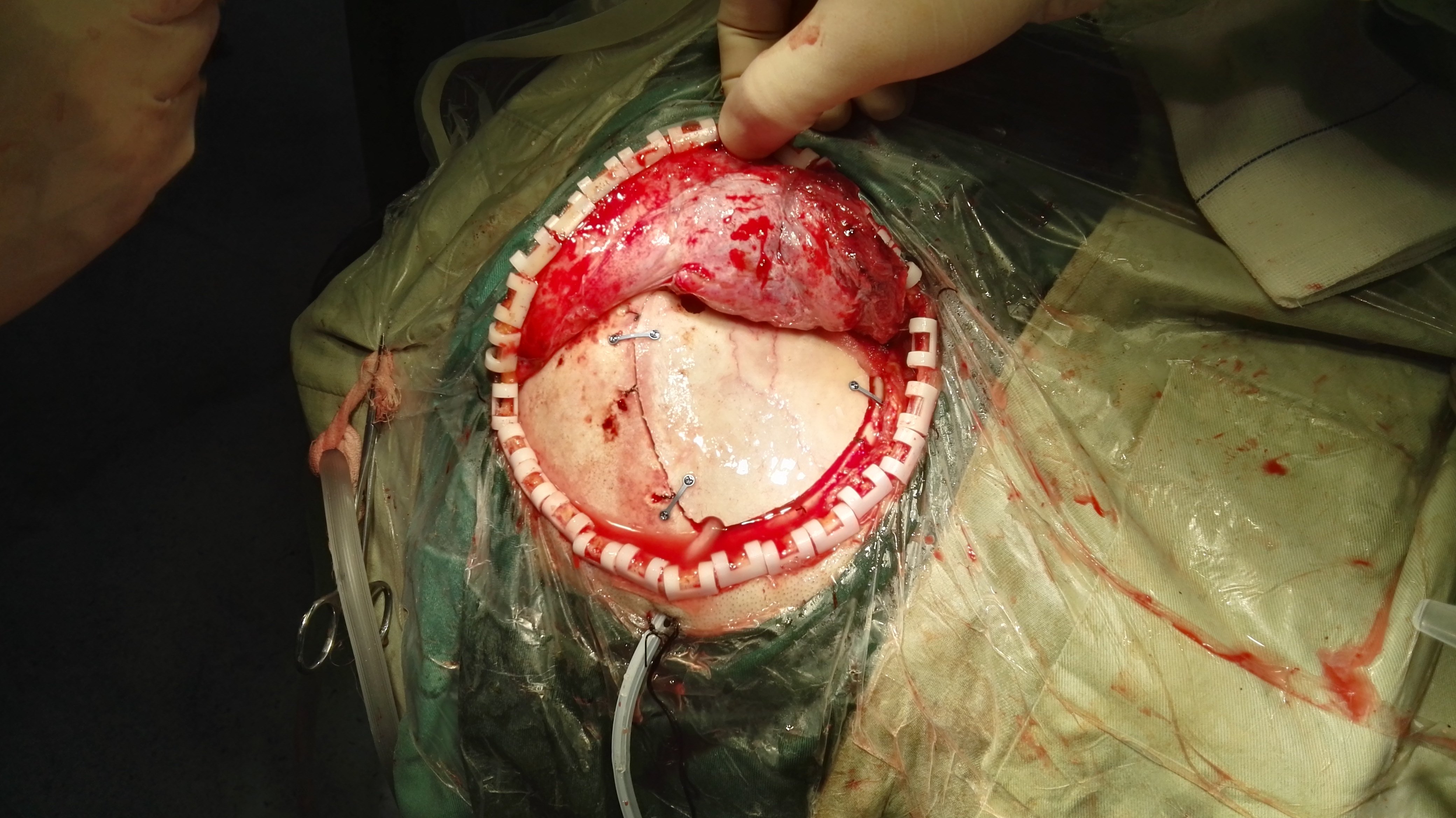 脑膜瘤一例 - 好大夫在线