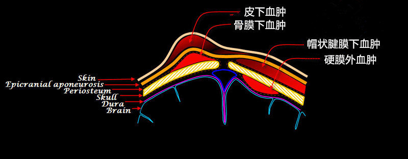 头皮血肿是怎么来的?又是怎么没的?