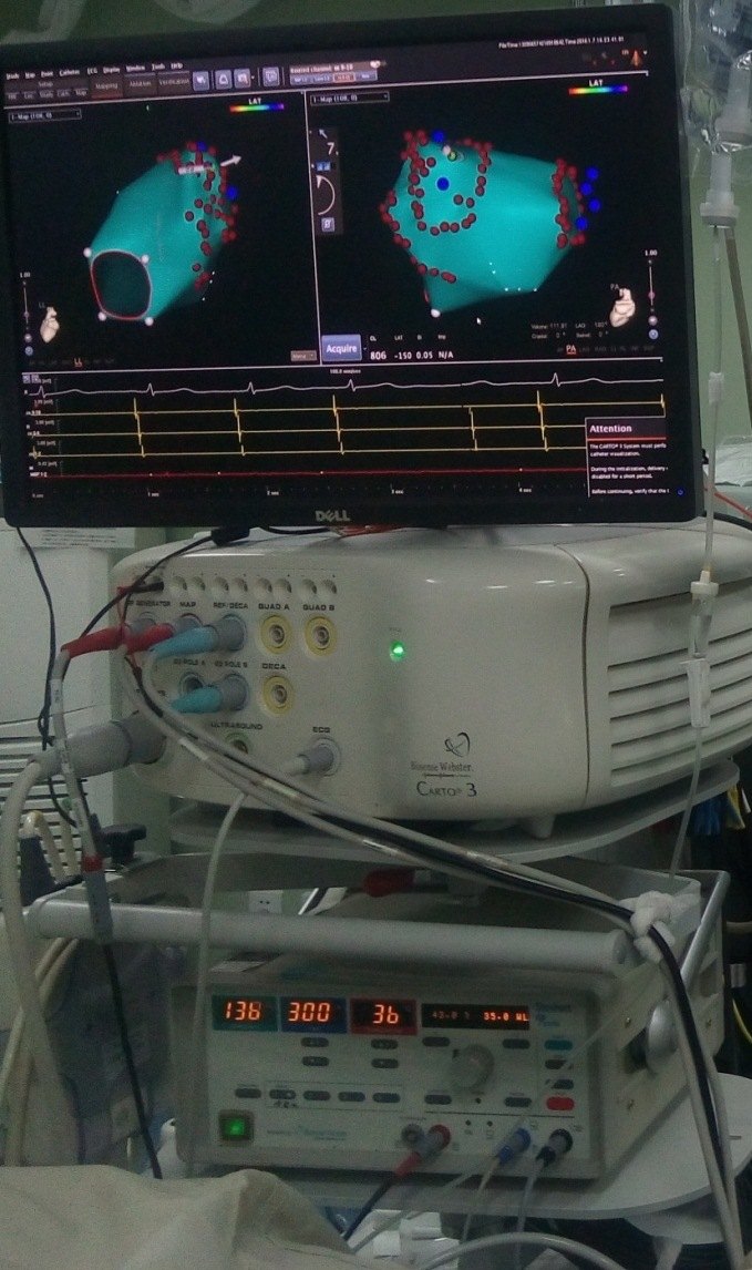美国强生公司carto3三维标测系统