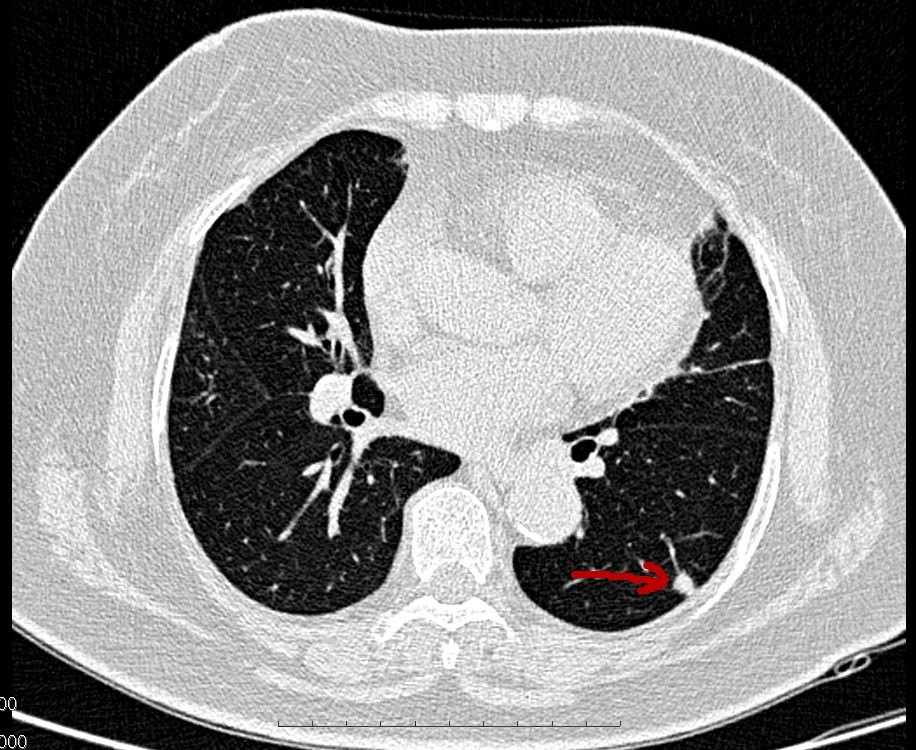 关于肺部小结节,磨玻璃样病变问题的解答--真实病例分析篇 - 好大夫