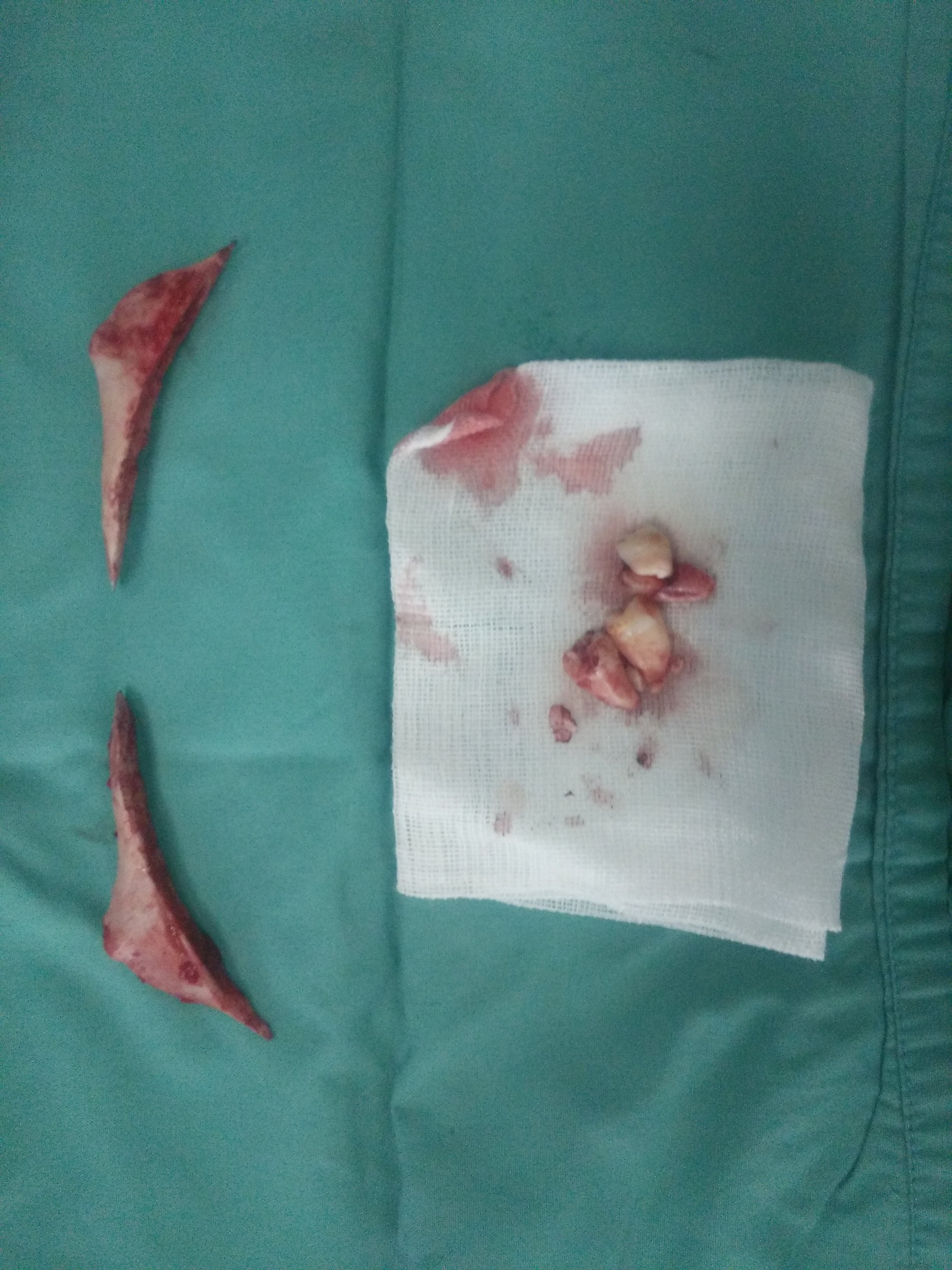 下颌角弧形截骨 - 好大夫在线