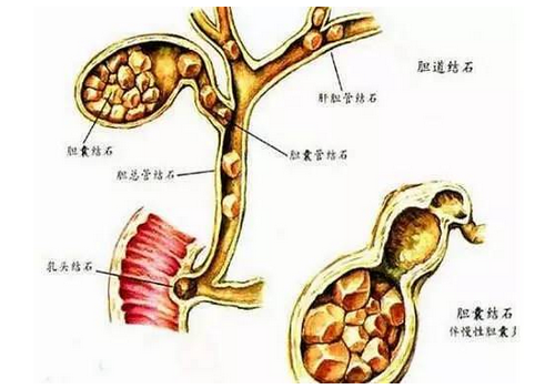 巧取"胆管结石"
