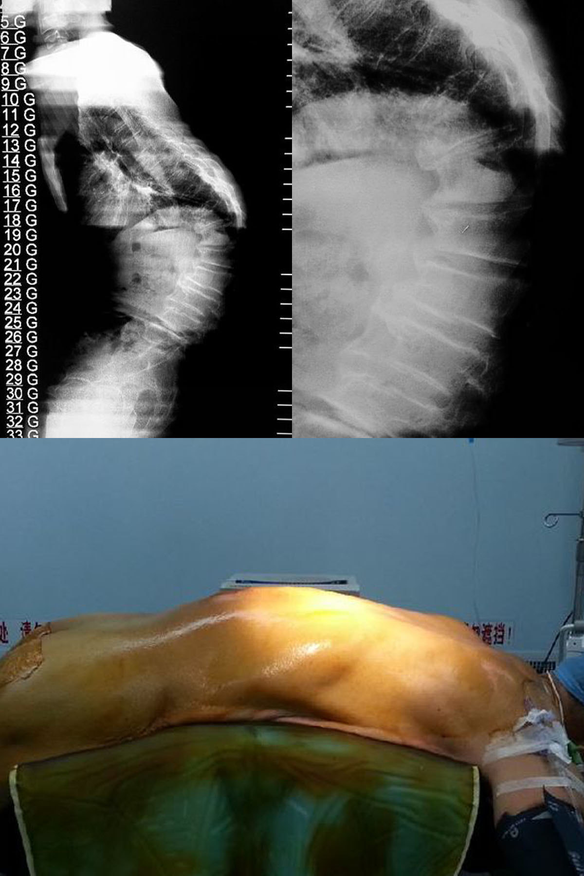 驼背畸形图片手术图片