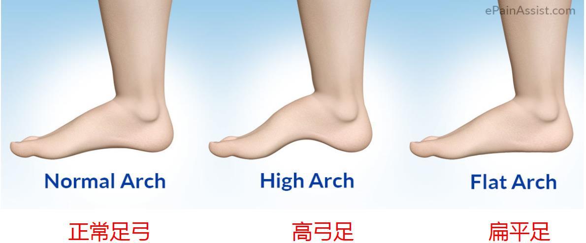 咱们正常的足,有一个相对较小的足弓弧度,可以用于缓冲地面对足的冲击