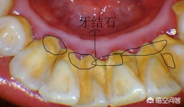 牙结石的分度图片图片