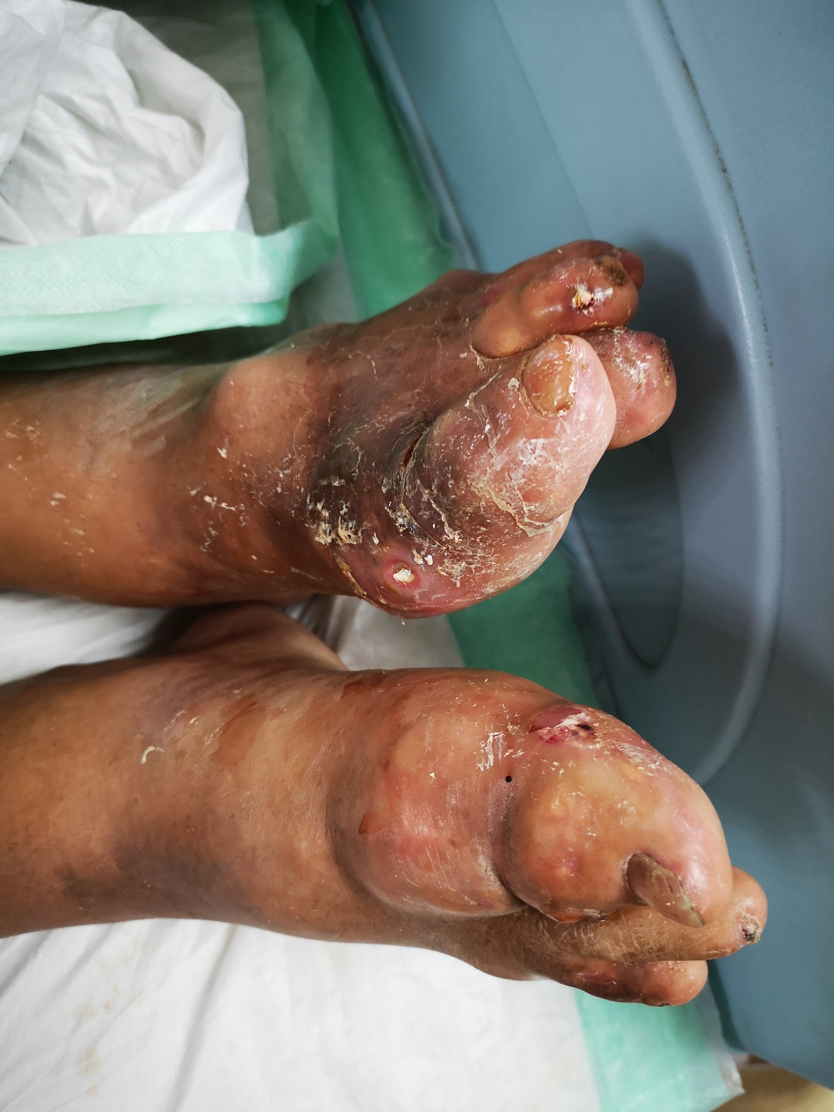 手腕关节痛风结石手指关节痛风结石