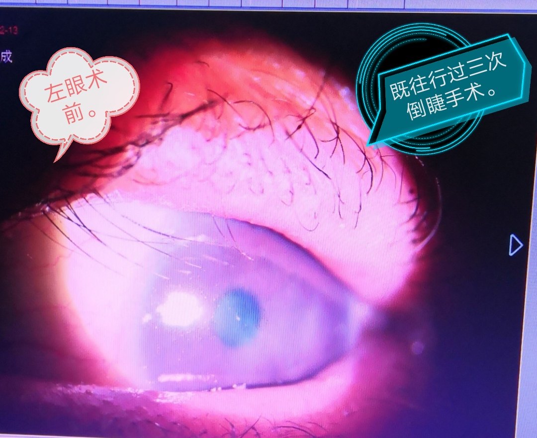 2019/01/25上睑倒睫术后睁眼,对称,双眼皮美观,睫毛均朝外上方生长.