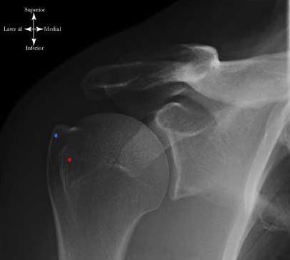 如何比较精准地来测量肩关节肱骨大结节骨折的移位程度么?