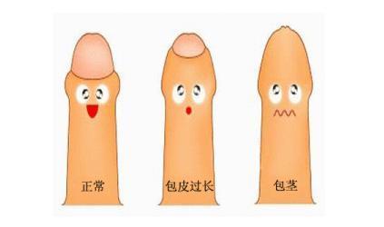 包皮过长包茎有啥危害哪些人要切包皮