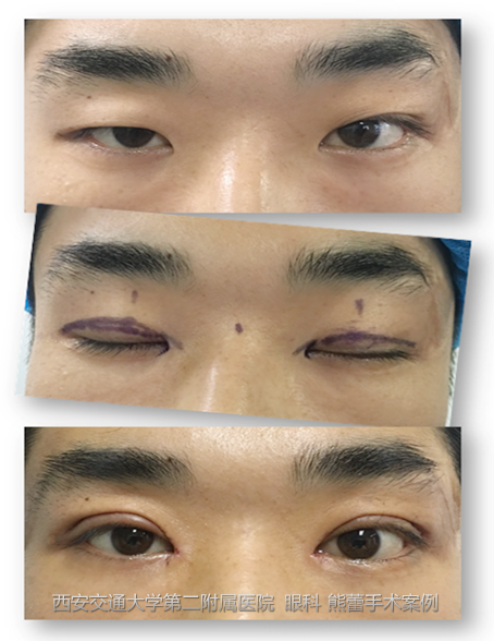 为什么眼睛总是流眼泪睁不开 u4YBAFw0l7qARgYNAAUvdaCKAI8969.png?_ms_=3a25