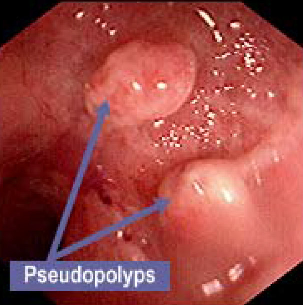 炎性假息肉-Pseudopolyps IBD Endosc - UpToDate.jpg