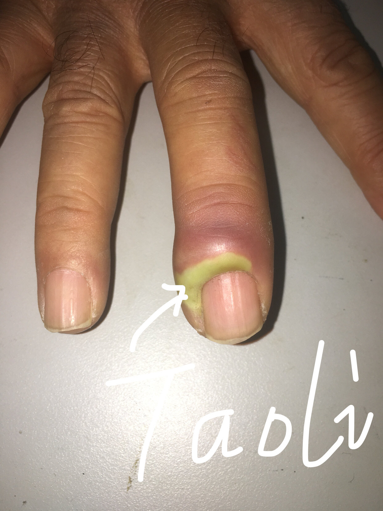 手指异物刺伤引起的感染 