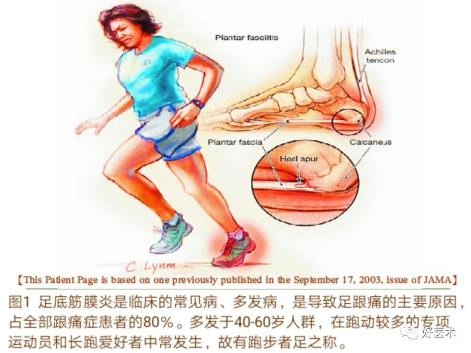 一文詳解:足底蹠筋膜炎的診治策略 - 好大夫在線