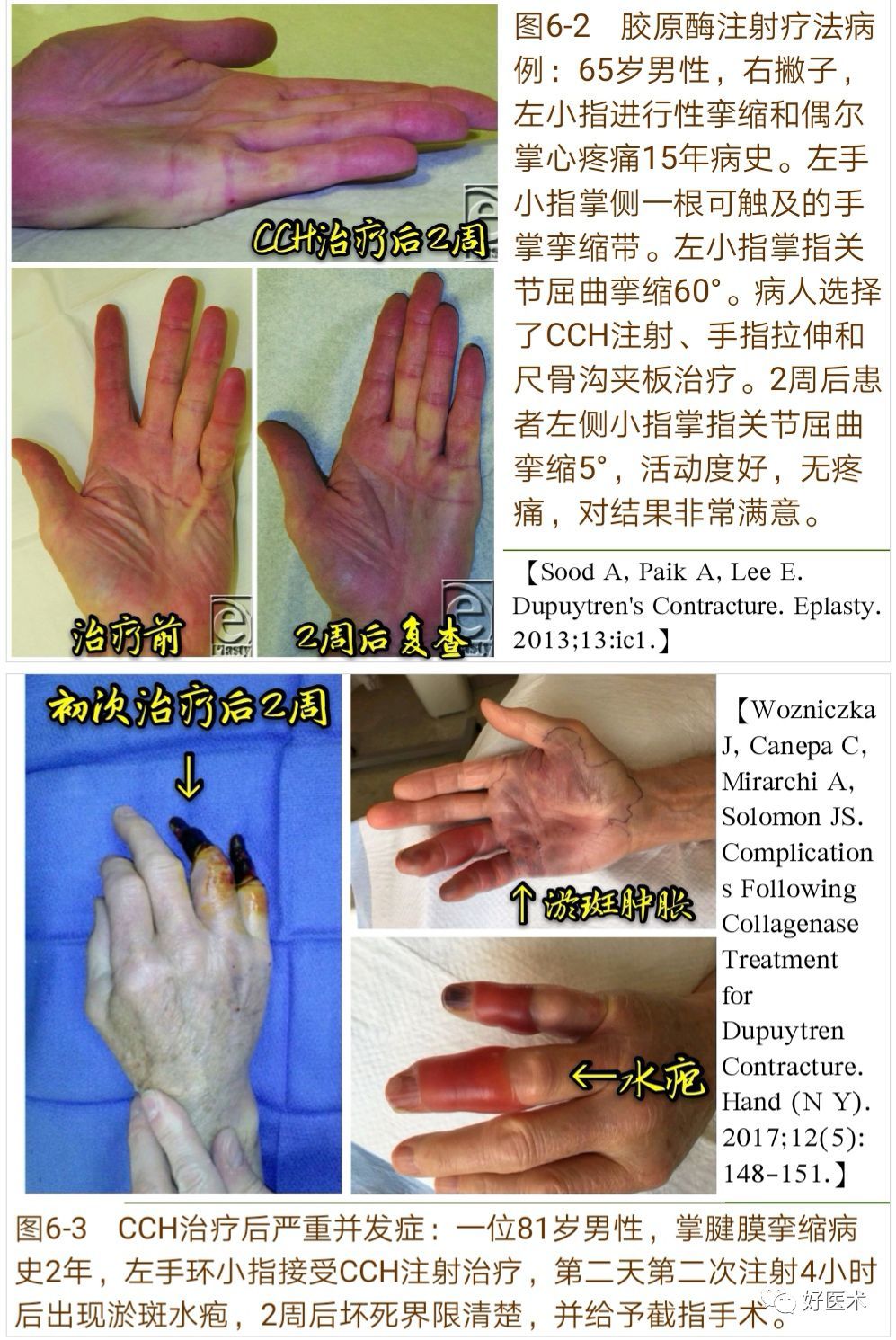 掌腱膜挛缩症的诊治技巧 系统详解 好大夫在线 掌腱膜挛缩症的诊治技巧 系统详解 好大夫在线