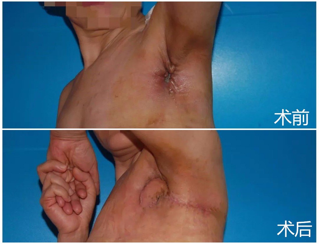 据了解,此前患者因左侧乳腺癌根治术后多次化疗至左侧腋窝出现疤痕